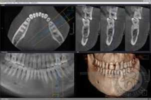 Как ставят зубные импланты видео видео Люми-Дент