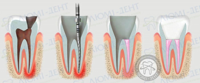 Удаление нерва зуба фото