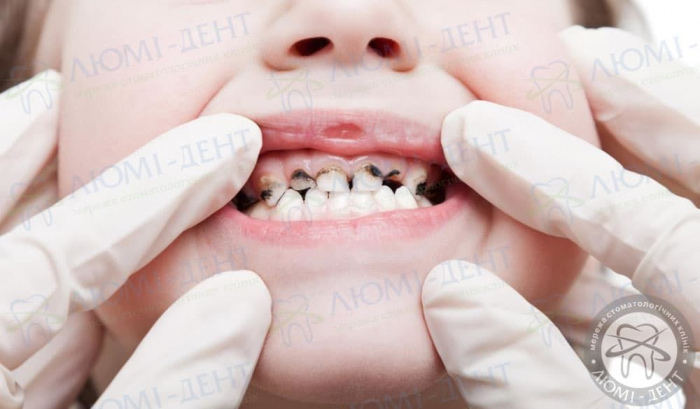 Почему чернеют зубы фото Люми-Дент