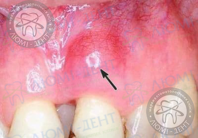 Зубной Флюс на десне абсцесс лечение фото Люми-Дент 