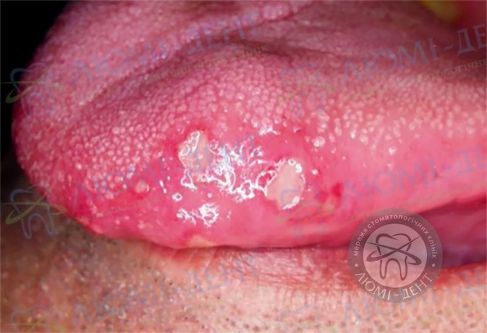 Герпес во рту лечение фото ЛюмиДент