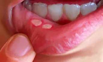 Сыпь на губе фото Люми-Дент
