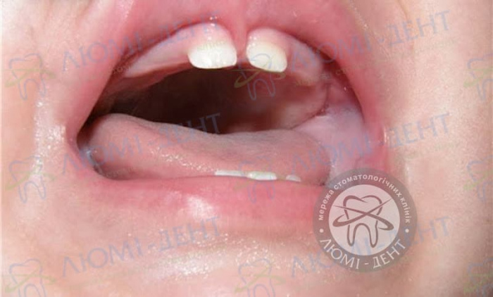 Хірургічна пластика вуздечки губ при Діастемі фото Люмідент