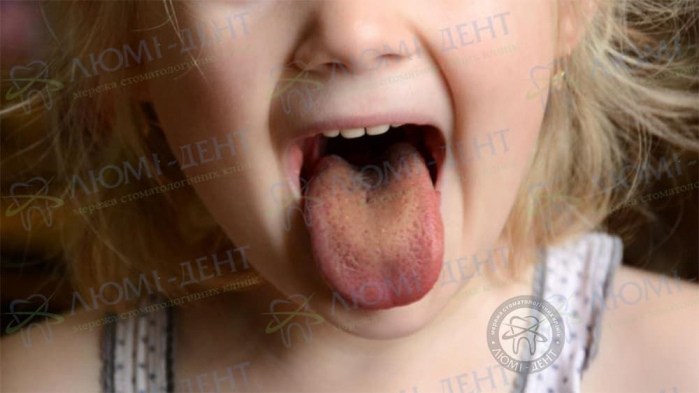 Коричневый язык у ребенка фото ЛюмиДент