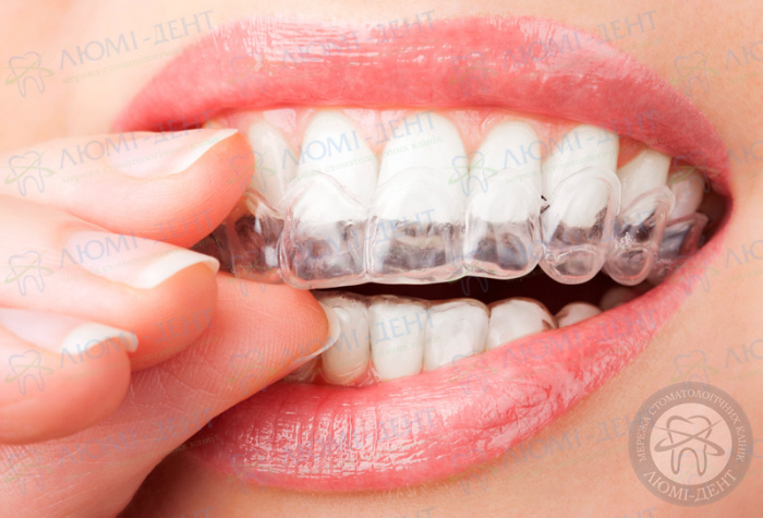 Накладки на зубы люминиры фото ЛюмиДент