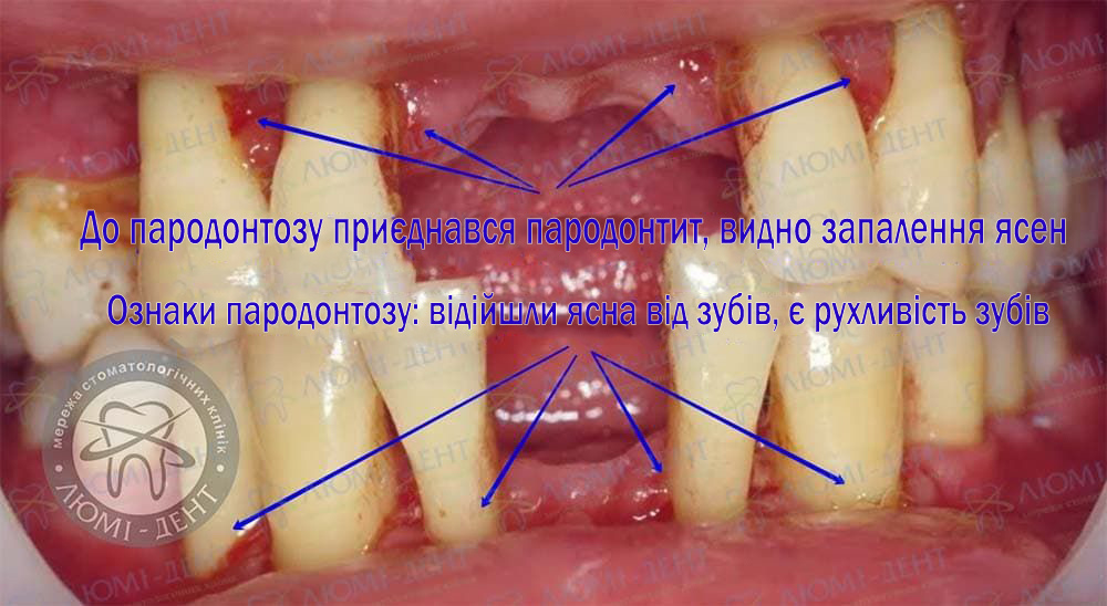 Пародонтит у ребенка фото
