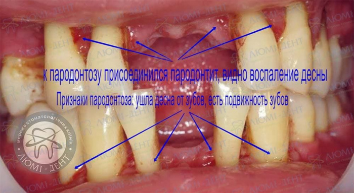 Пародонтоз зубов лечение фото Люми-Дент