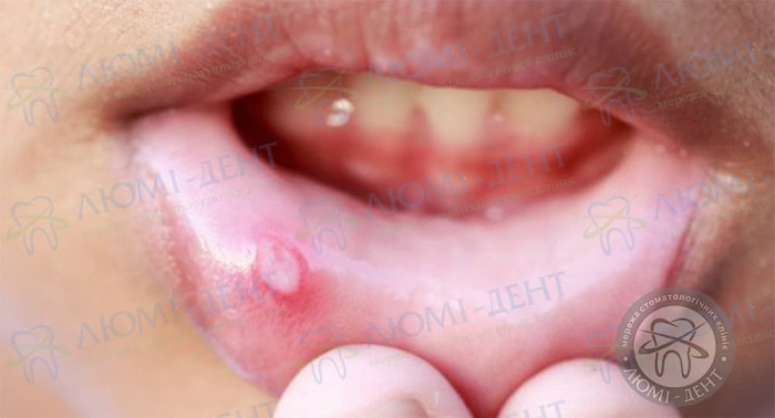 Болячка на губе фото ЛюмиДент