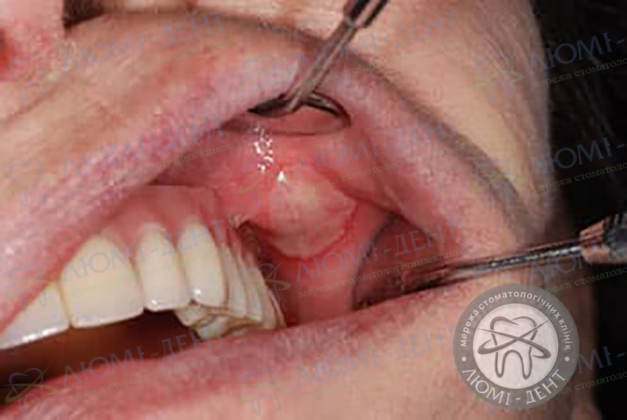 Инфекционный стоматит во рту у взрослых фото Люмидент