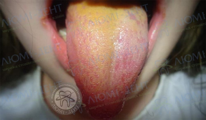жовтий язик у дитини фото ЛюміДент