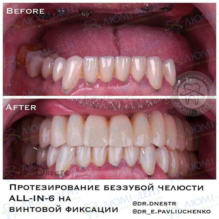 Имплантация зубов фото до и после фото Люми-Дент