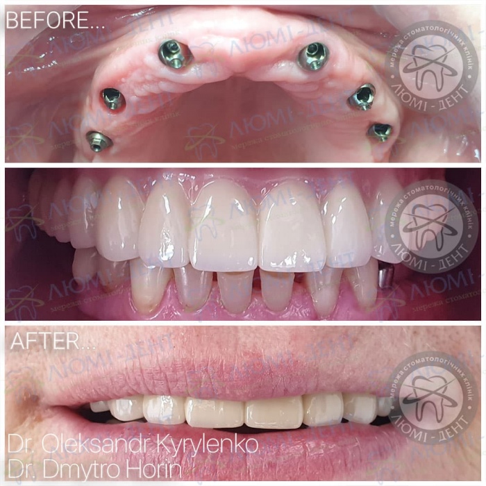 Зубные импланты фото Люми-Дент