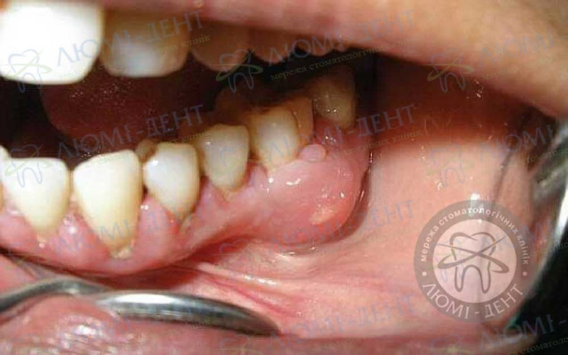 Toothache photo Lumi-Dent