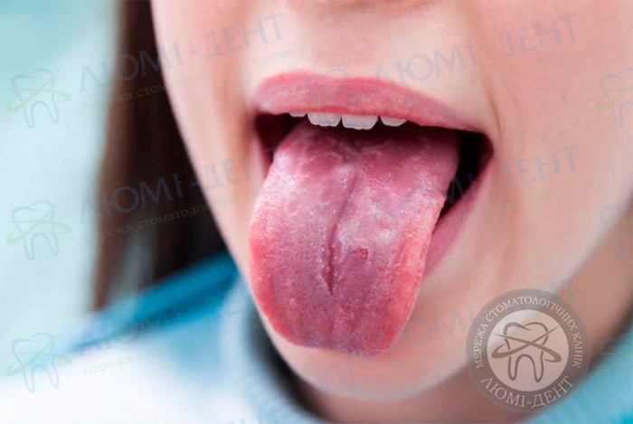 Німіє кінчик язика фото ЛюміДент