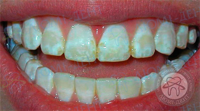Оскома на зубах фото ЛюмиДент