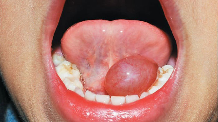 Воспаление под языком фото Люмидент