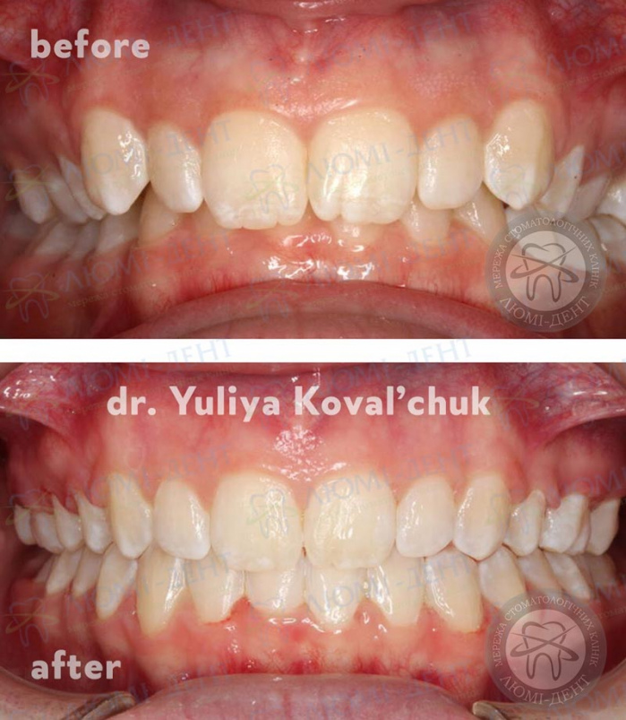 Ортодонтичні скоби для зубів фото ЛюміДент