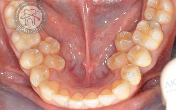 Сверхкомплектные зубы фото ЛюмиДент