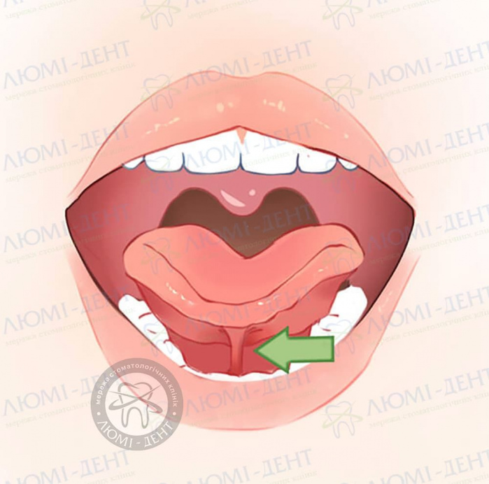 Вуздечка язика фото ЛюміДент
