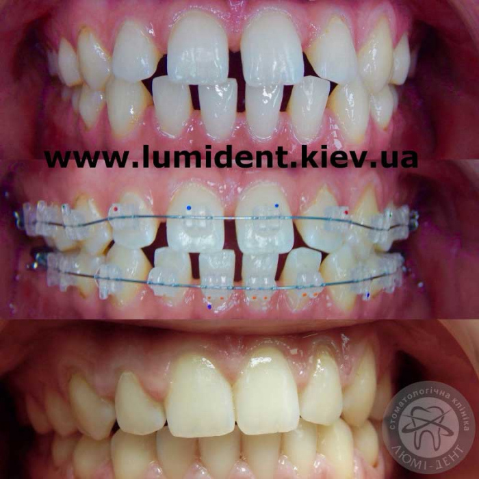 The result of the braces photo Lumi-Dent