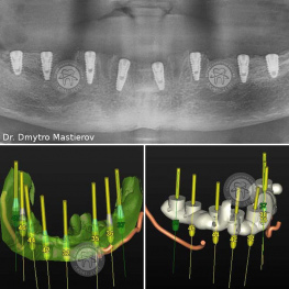 Операція імплантації зубів Люмі-Дент