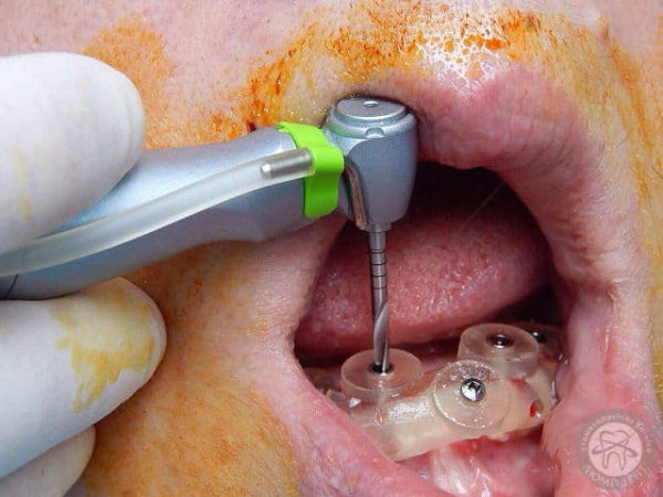 Видео Имплантация зубов Люми-Дент