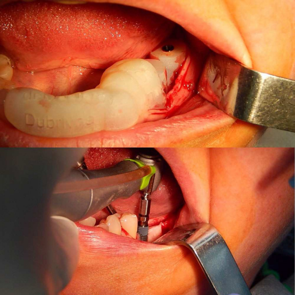 Видео имплантации зубов фото Люмидент