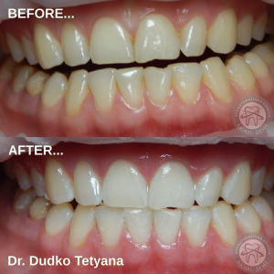 Отбеливание зубов фото до и после 