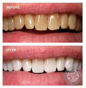 отбеливание зубов киев, фото, до и после