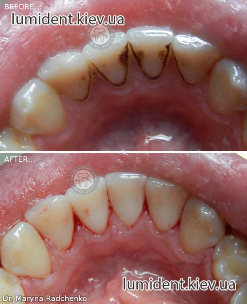 Чищення зубів у стоматолога Київ фото Люмідент