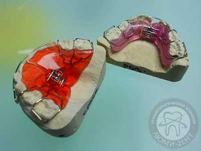 детская пластина для зубов для исправления прикуса Киев Люмидент