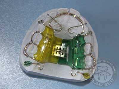 Ортодонтическая пластинка фото Люми-Дент