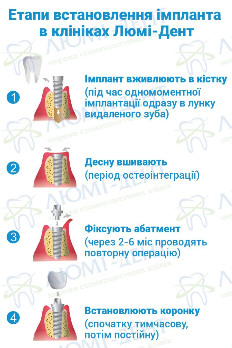 Етапи установки зубних імплантів в Люмі-Дент Імплантація зубів верхньої нижньої щелепи фото Люмі-Дент
