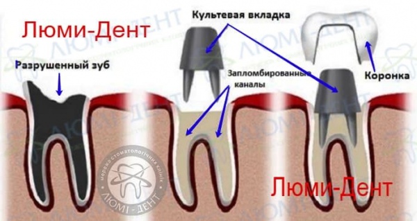 Металлокерамика зубов коронки фото Люми-Дент