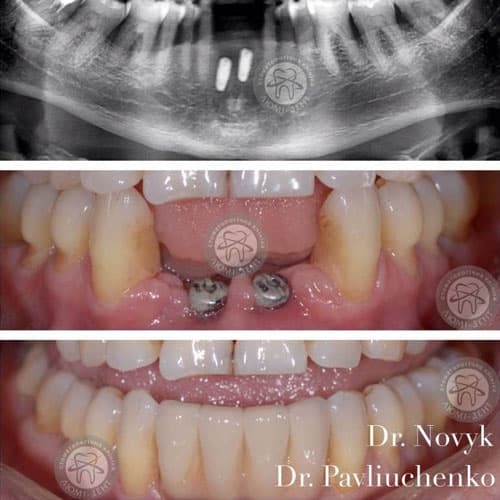 Установка металлокерамических зубов фото Люми-Дент