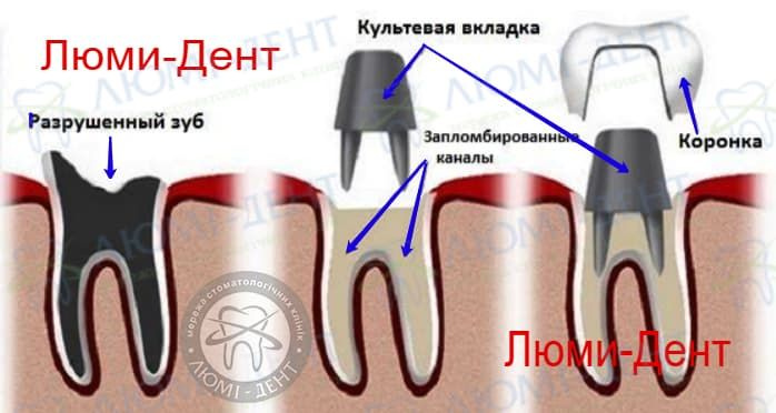 Как Выглядит Коронка Зуба Фото