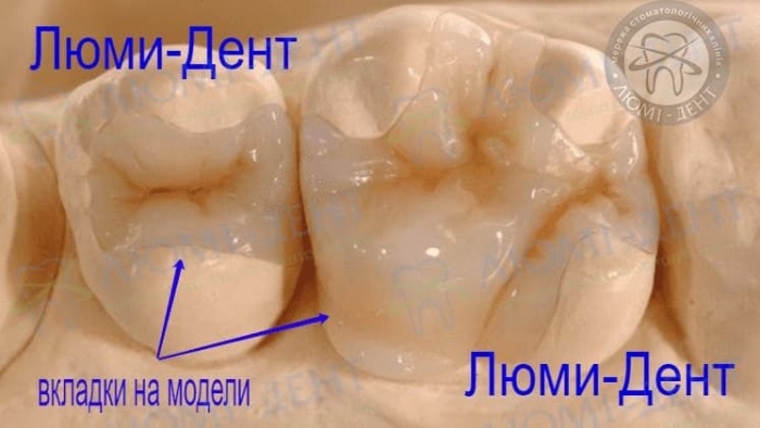 Зубная вкладка на зубы фото Люми-Дент