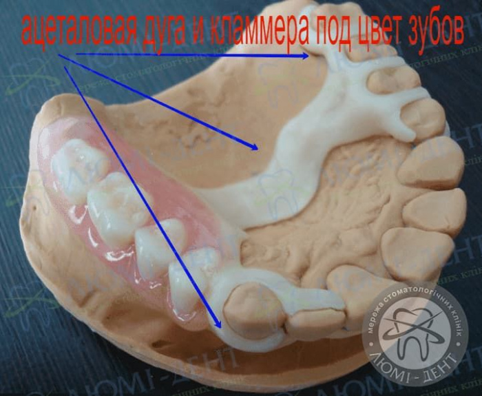 Съемные протезы зубов фото Люми-Дент