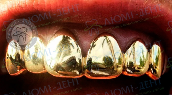 Вставить золотые зубы фото ЛюмиДент