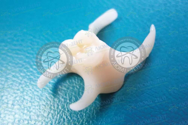 Частичный съемный протез на один зуб фото Люми-Дент