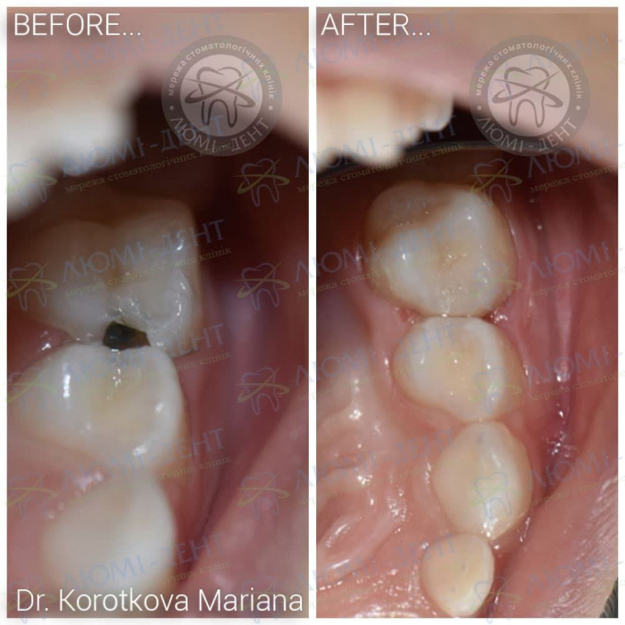 Лікування зубів дитині під наркозом фото ЛюміДент