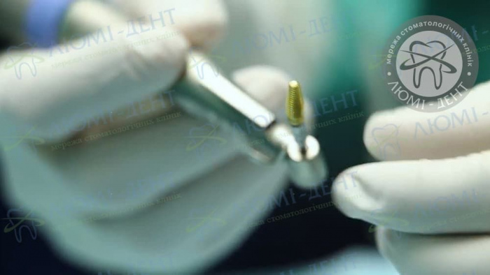Как ставят импланты на передние зубы фото Люми-Дент