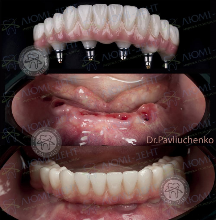 Восстановление зубов имплантация фото Люми-Дент