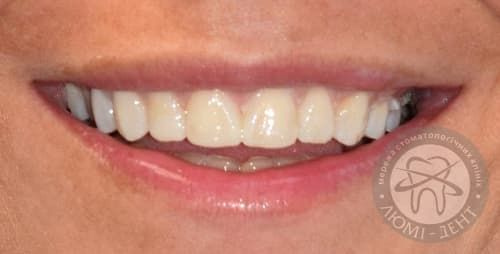 Stages of installing veneers in the Lumi-Dent clinic