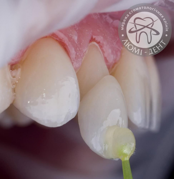 Примерка виниров на зубы фото Люми-Дент