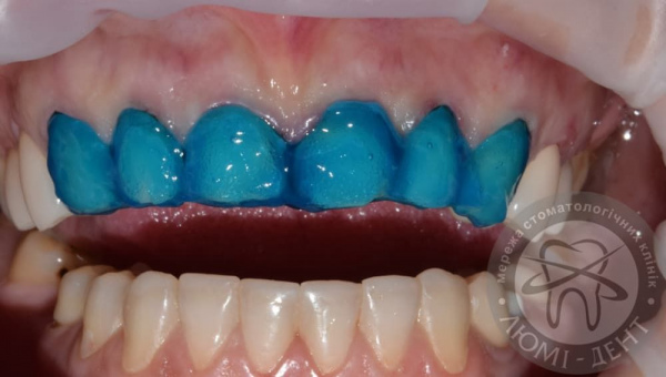 Teeth processing for veneers photo Lumi-Dent