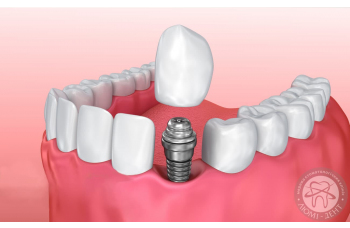 Що таке імплантація зубів?