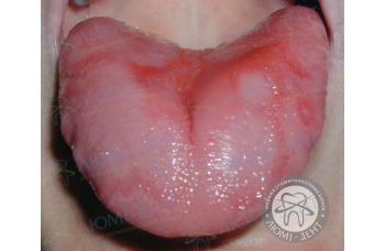 печіння в роті фото ЛюміДент