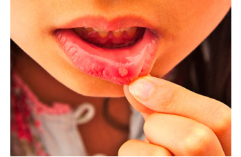 Стоматит у роті у дорослих лікування Київ фото Люмі-Дент