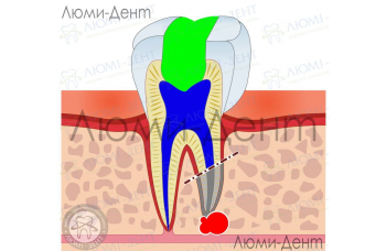Гемісекція зуба